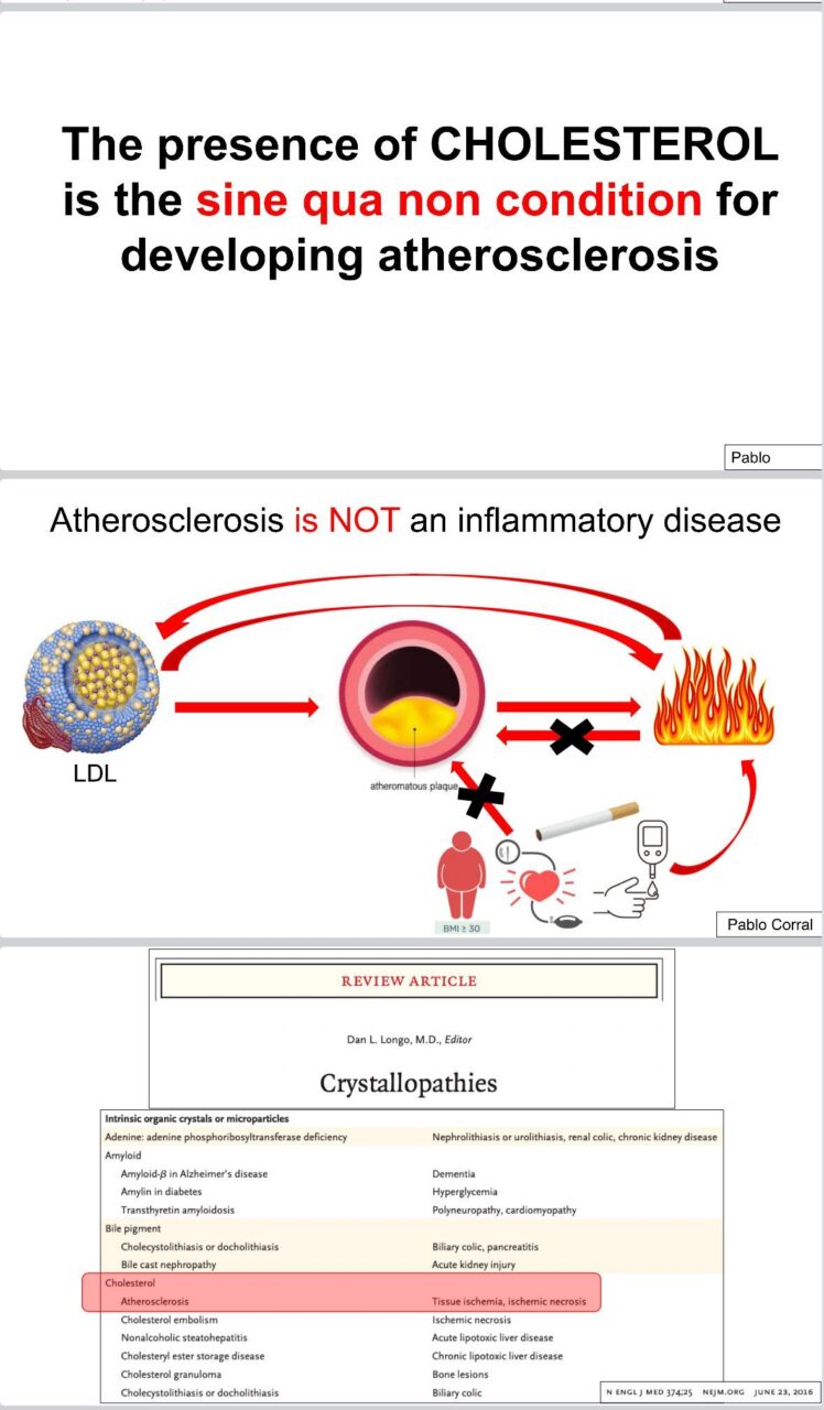 Pablo Corral: Atherosclerosis Is NOT an Inflammatory Disease 1 Pablo Corral: Atherosclerosis Is NOT an Inflammatory Disease