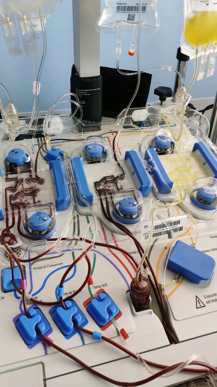 Maxime Dely: Therapeutic Apheresis - How Do You Know When You Can’t Wait Any Longer? 1 Maxime Dely: Therapeutic Apheresis - How Do You Know When You Can’t Wait Any Longer?