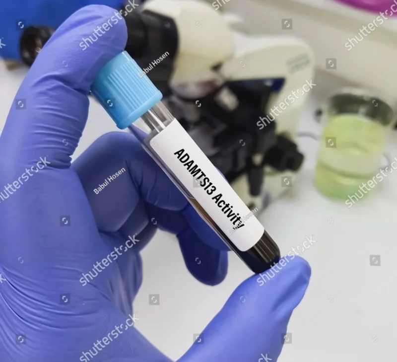 Tareq Abadl: The Critical Role of ADAMTS13 Activity Testing in Diagnosing TTP