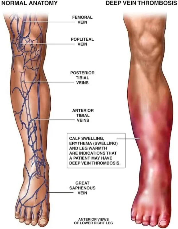 Vivek Mahto: Understanding Deep Vein Thrombosis - Causes, Symptoms, and Prevention 1 DVT