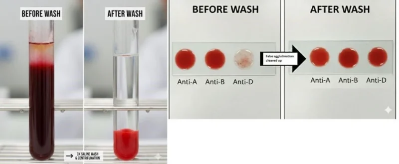 Yves Bikorimana: Before Wash vs After Wash in Blood Grouping 1 Yves Bikorimana: Before Wash vs After Wash in Blood Grouping