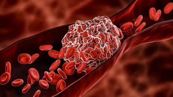 Alan Nurden: How P-Selectin Inhibition Can Help Thrombus Resolution