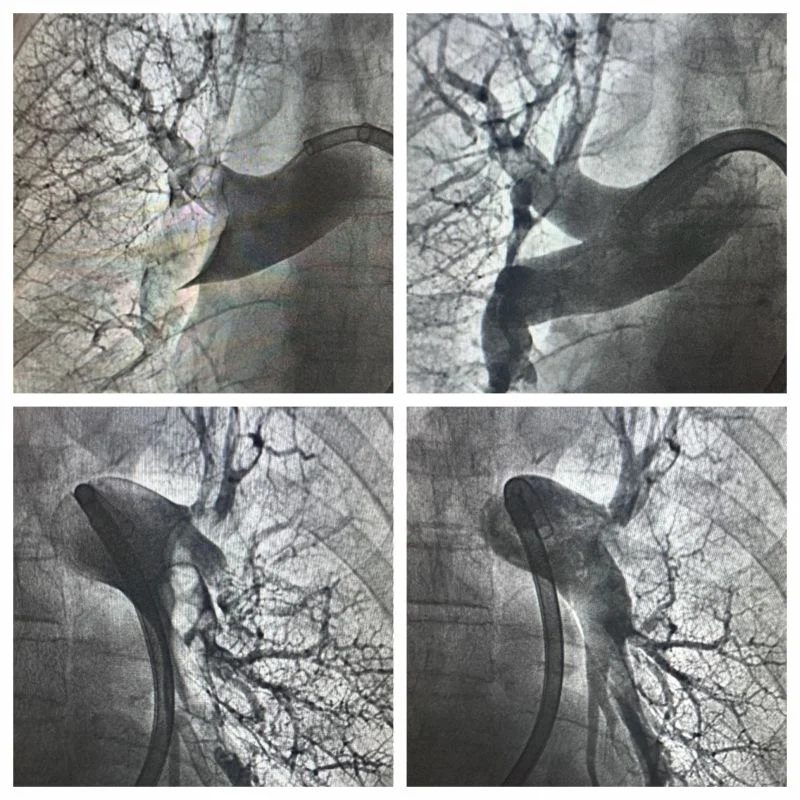 Jesse Solar Explains Pulmonary Embolism