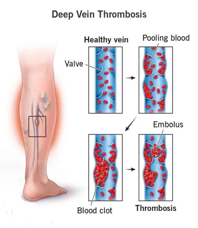 Hariom Rajput: Early Recognition and Prevention of Deep Vein Thrombosis