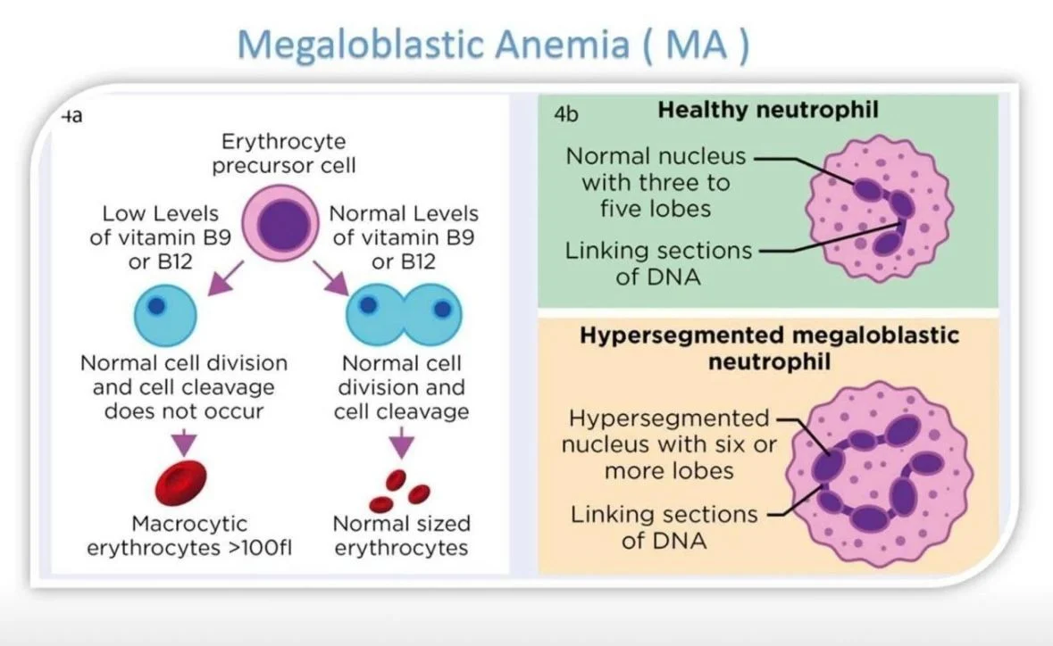 Omar Adwan: Clinical and Laboratory Features of Megaloblastic Anemia