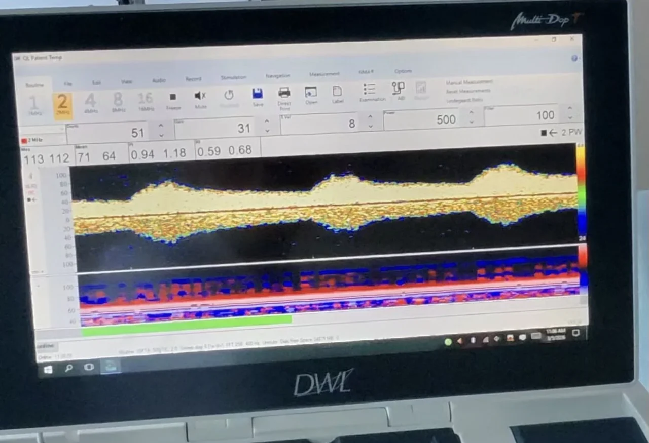 Reza Bavarsad Shahripour: When the Ophthalmic Artery Tells the Story of the Carotid