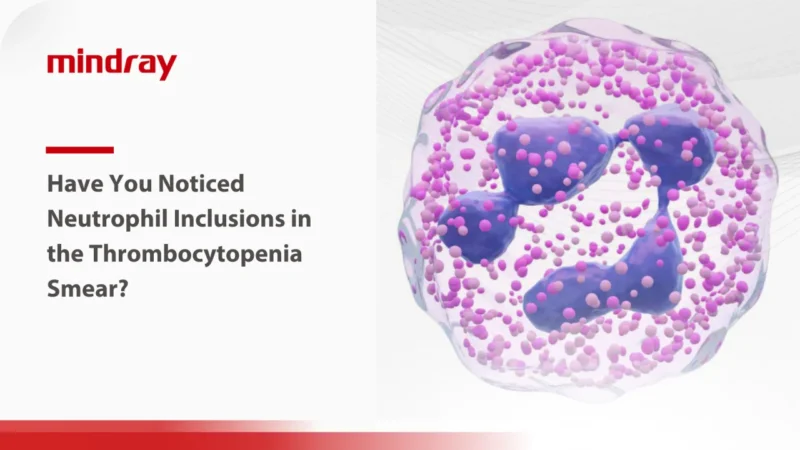 Rameez Ashraff: Have You Noticed Neutrophil Inclusions in a Thrombocytopenia Smear?