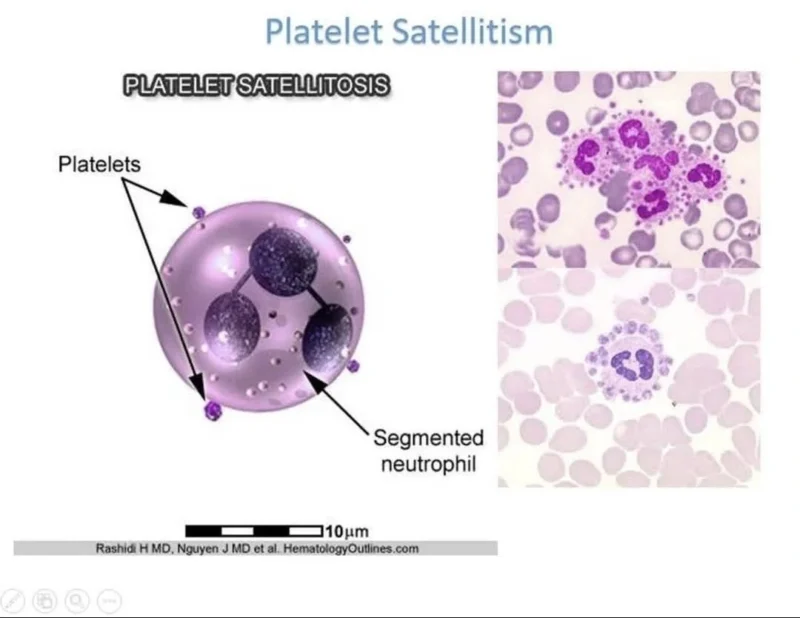 Seema Dawood: Platelet Satellitism - An EDTA-Dependent Cause of Pseudothrombocytopenia