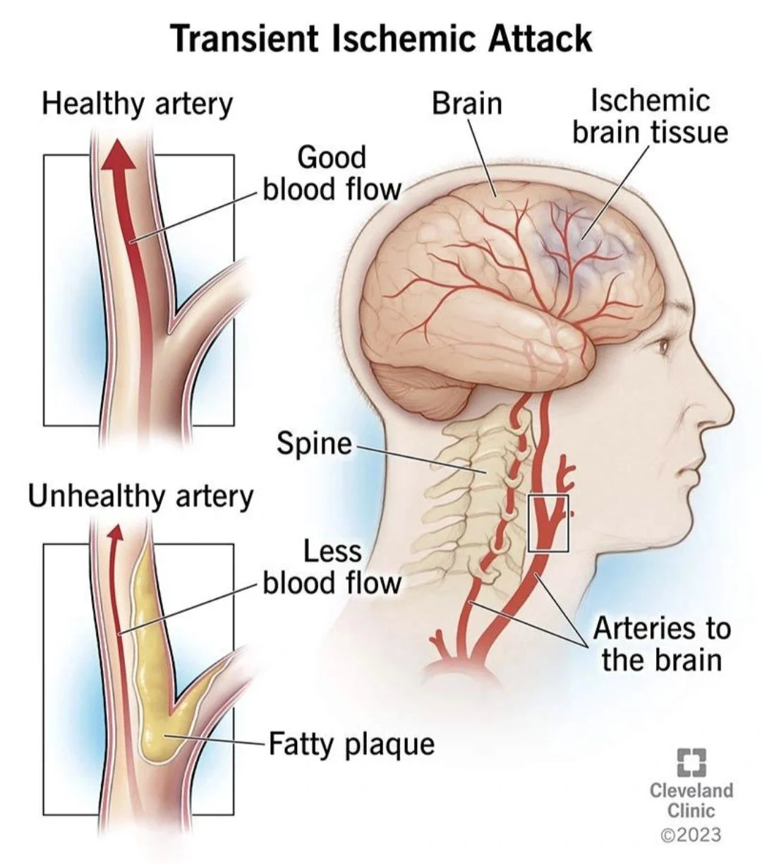 Huseyin Altaeh: Transient Ischemic Attack as a Warning Sign of an Impending Stroke