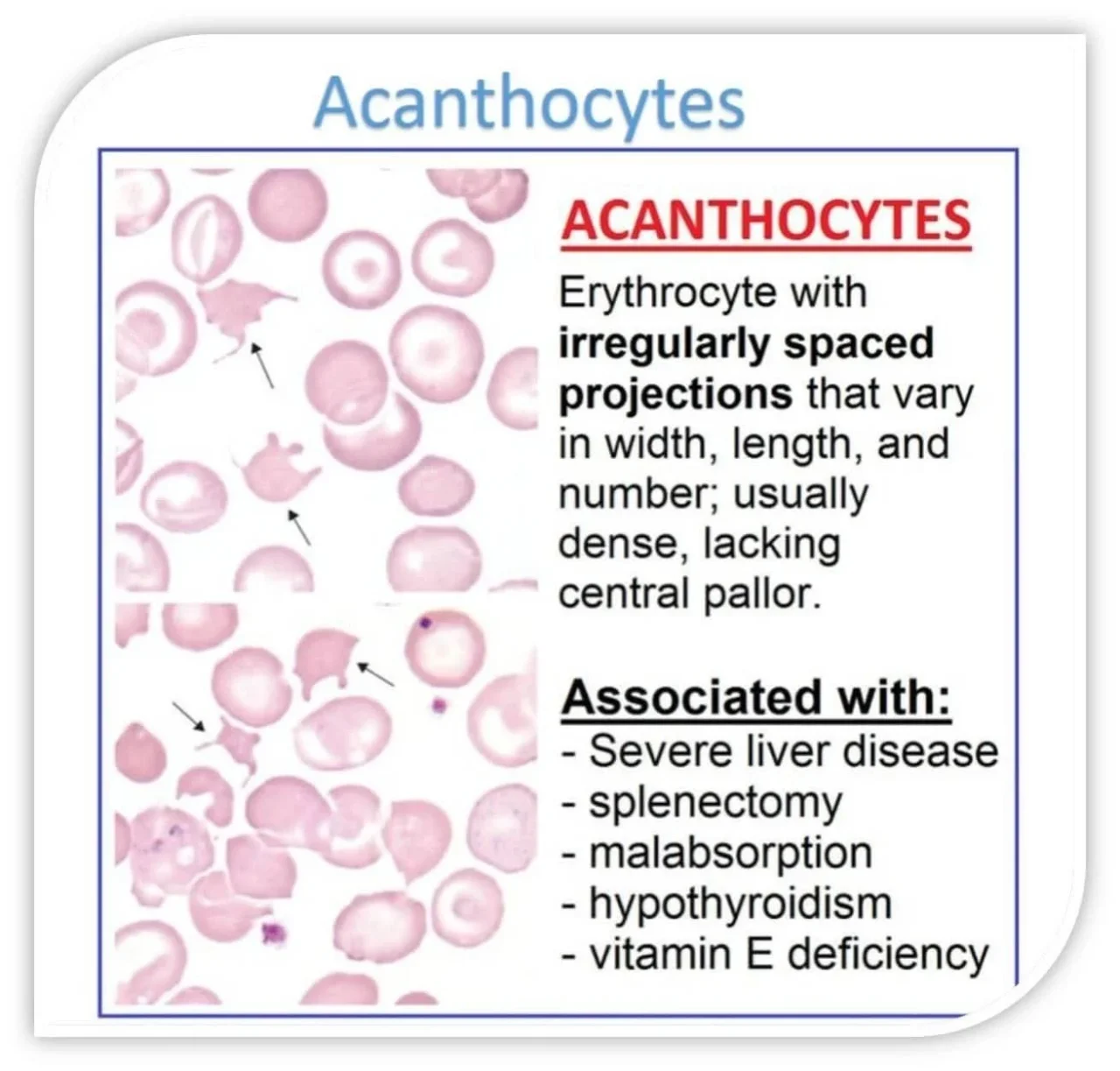 Omar Adwan: Understanding Clinical Significance and Diagnostic Implications of Acanthocytes 1 Omar Adwan: Understanding Clinical Significance and Diagnostic Implications of Acanthocytes