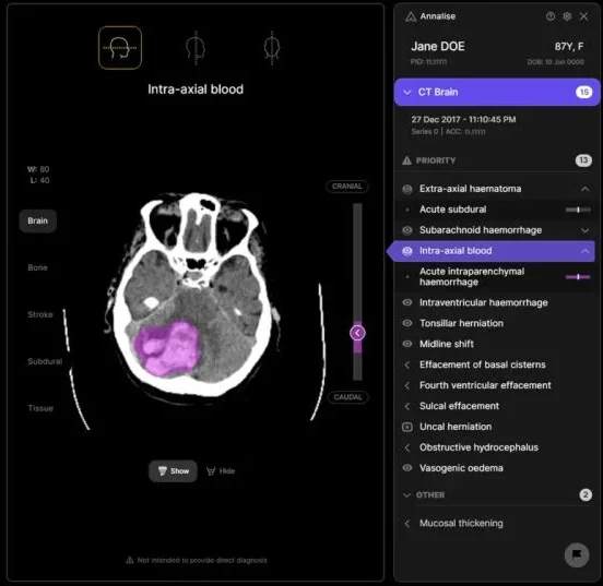 Ahmad Alenezi: Harrison.ai Secured Its 13th FDA Clearance, And This One Is a Literal Life-Saver
