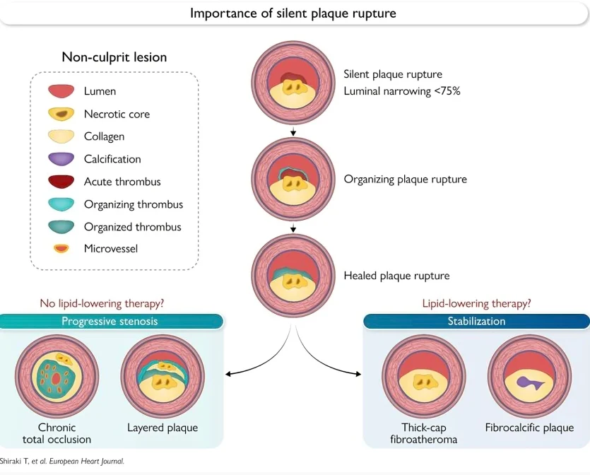 Aloke Finn: The Role of Silent Plaque Rupture in Atherosclerotic Disease Evolution