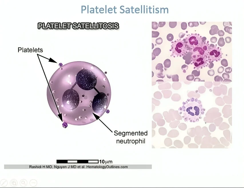Seema Dawood: EDTA-Induced Platelet Satellitism