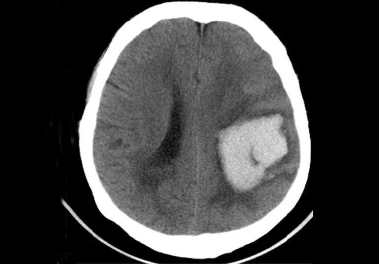 Kayley Pappas: Translating Cutting-Edge Science Into Better Care and Hope for Stroke Patients at Mayo Clinic