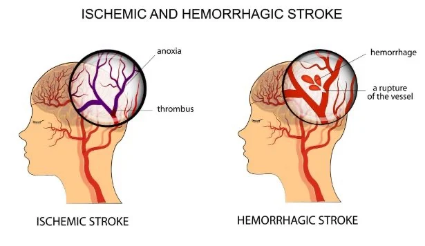William Tembo: Understanding Stroke Through Landmark Clinical Trials