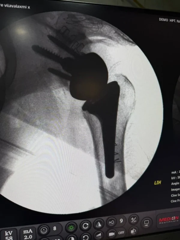 Varun Bafna: The Power of Extended Half-Life Factor IX in Enabling Safe Major Surgeries