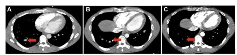 Khaled Kandil: A Rare Case of Recurrent Thromboembolism with Pulmonary Artery Aneurysms