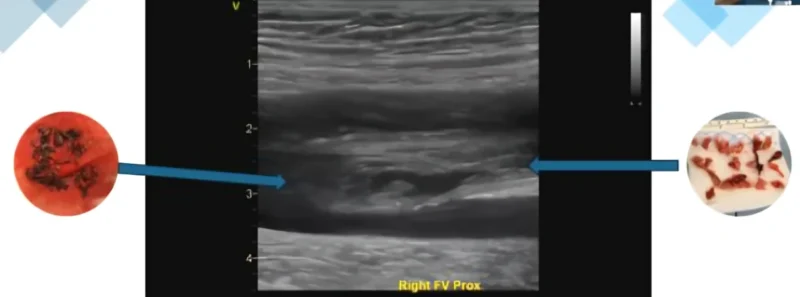 Venous Thromboembolism