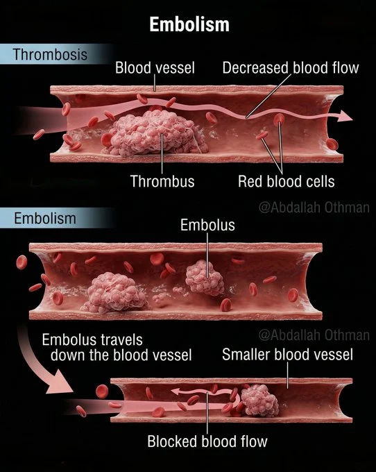 Abdallah Othman: Thrombosis Forms a Clot, Narrowing the Vessel and Reducing Blood Flow