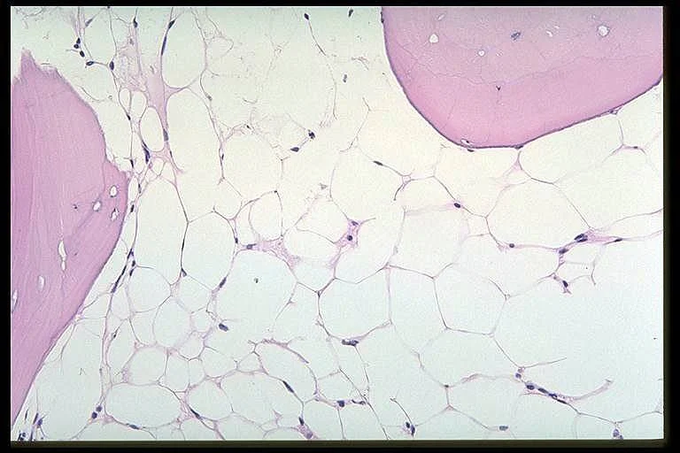 Mohammed Almohammadi: Etiologic Spectrum and Diagnostic Challenges of Hypocellular Marrow Findings