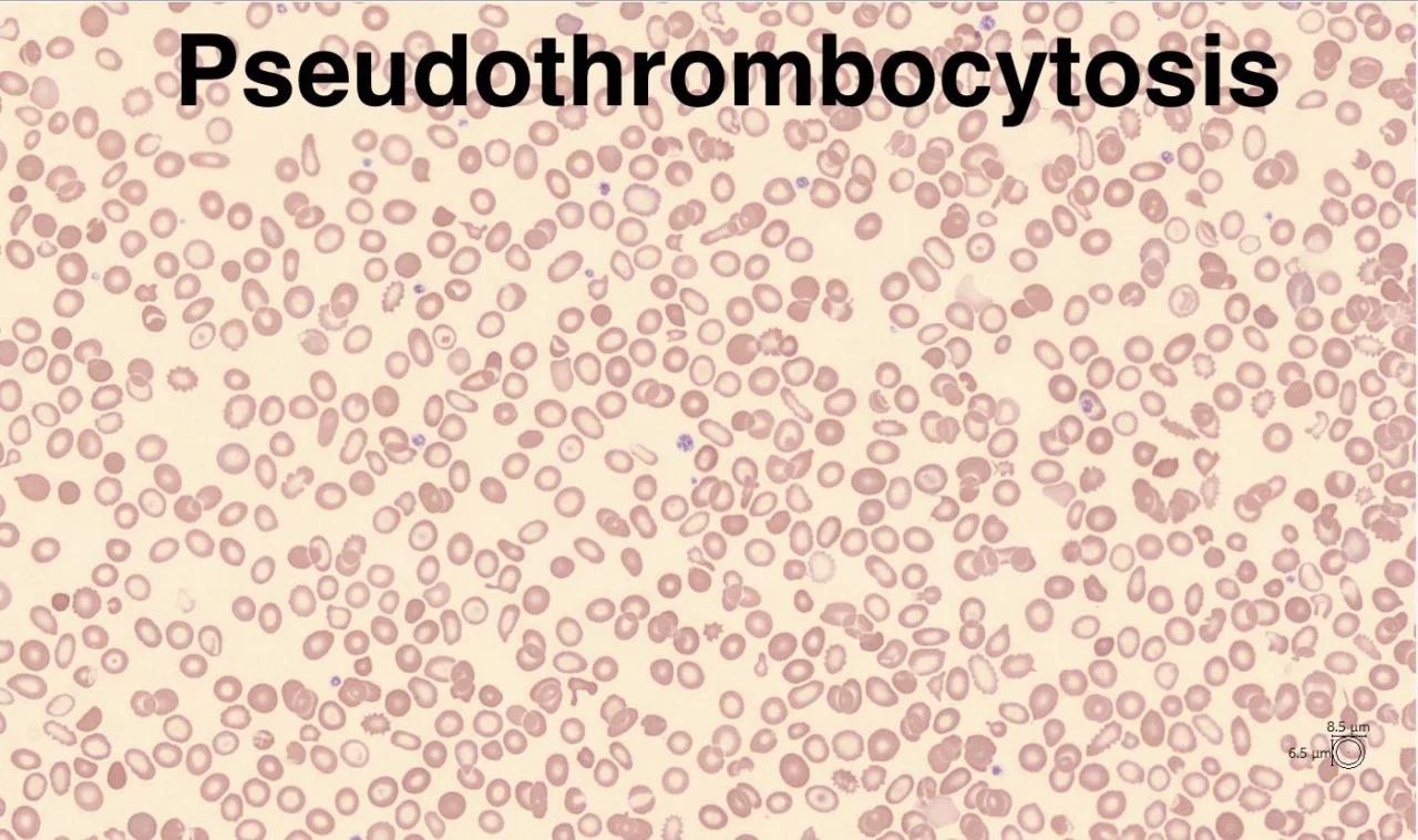 Saleh Shamse Basha: When Platelet Counts Mislead, The PLT-F Becomes Critical 1 Saleh Shamse Basha: When Platelet Counts Mislead, The PLT-F Becomes Critical