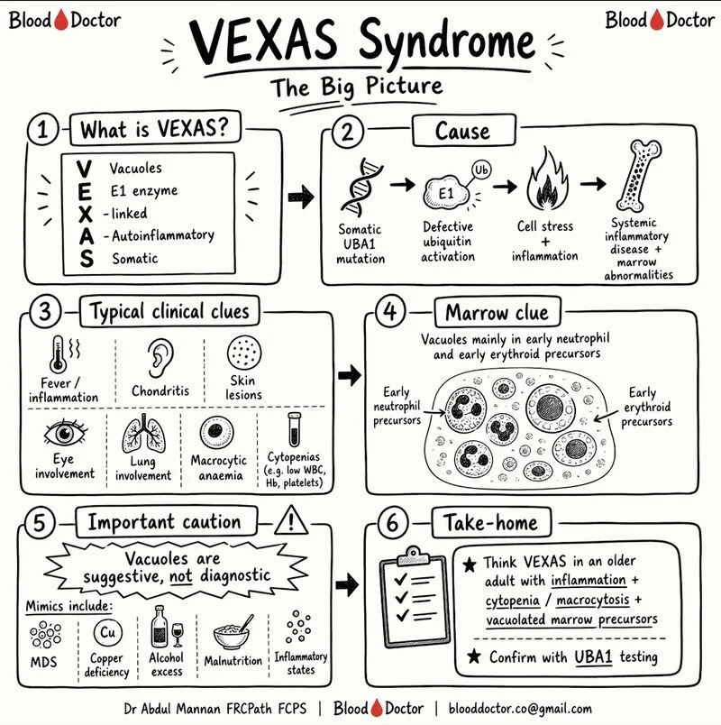 Abdul Mannan: The Clinical Pattern That Should Make You Think of VEXAS