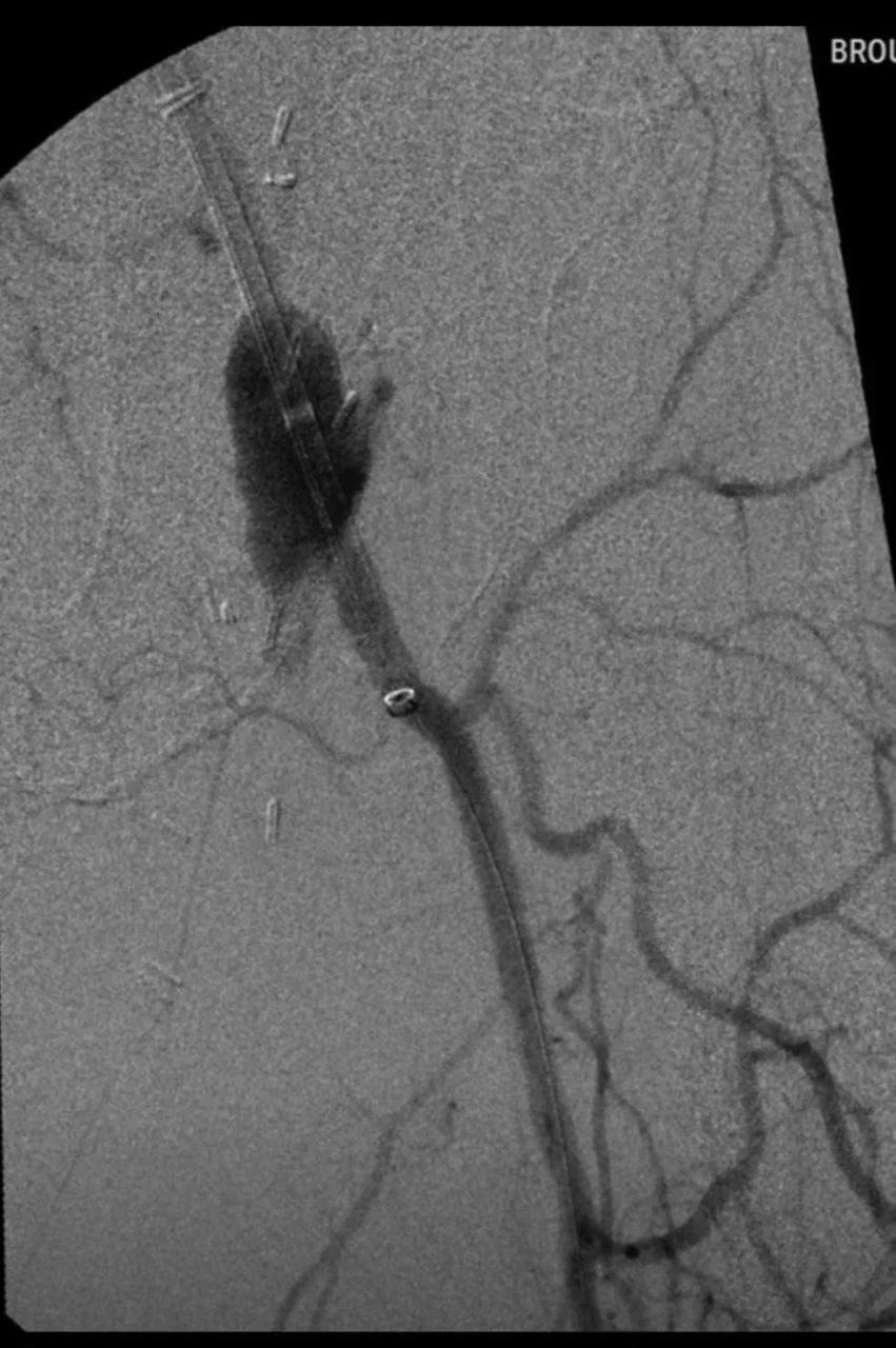 Carmen Ruiz: First Arterial Mechanical Thrombectomy in New Zealand Using the ARTIX System