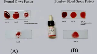 Sumyea Kabir: The Hidden Risk of Bombay Blood Group