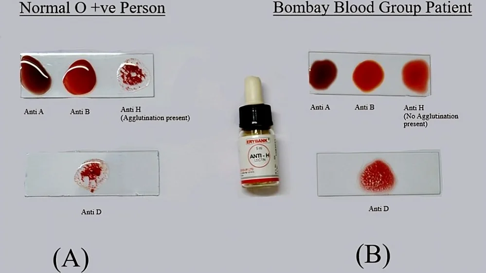 Sumyea Kabir: The Hidden Risk of Bombay Blood Group