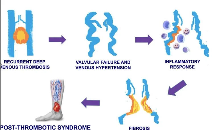 Julie Cardoso: Post-Thrombotic Syndrome - The Hidden Impact of DVT