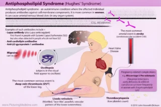 Sthanu Subramanian։ Understanding Antiphospholipid Syndrome and Its Thrombotic Risks