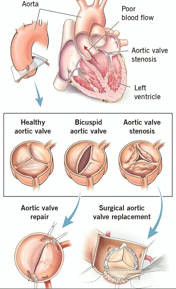 Ney Carter Borges: Early Surgery vs Conservative Care in Asymptomatic Very Severe Aortic Stenosis