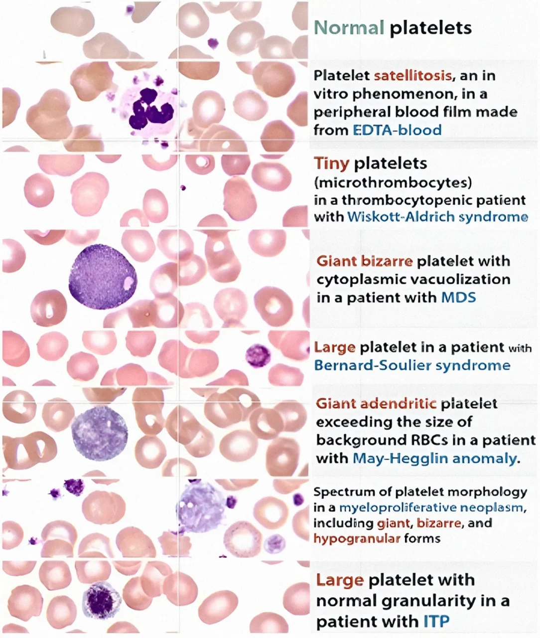 Peripheral Blood Smear (PBS) Under the Microscope: Bridging Morphology and Hematology