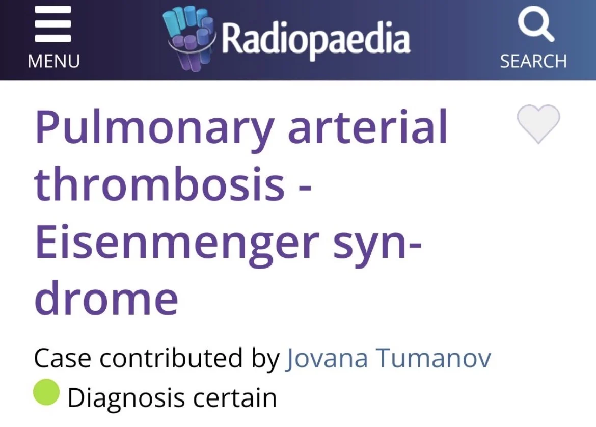 Nikola Grubor: In Situ Pulmonary Arterial Thrombosis Mimicking CTEPH in Eisenmenger 1 Nikola Grubor