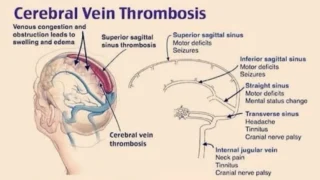 Sthanu Subramanian: CVST as The 'Great Masquerader' with Normal Initial CT