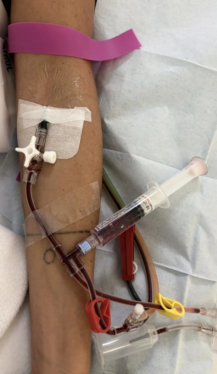 Maxime Dely: Venous Access in Apheresis Technology Isn’t Everything