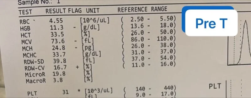 Charles Okyere Boadu: What Is The Most Likely Cause of Persistent Thrombocytopenia Despite Transfusion?