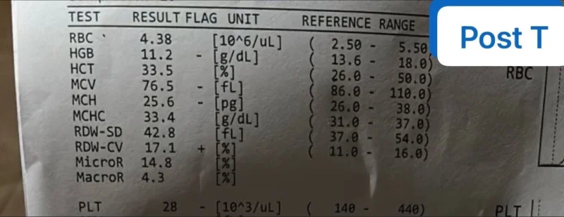 Charles Okyere Boadu: What Is The Most Likely Cause of Persistent Thrombocytopenia Despite Transfusion?