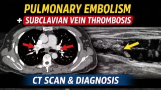 Elias Lee: Acute PE from Subclavian VT - CT Scan Diagnosis, Radiology Interpretation, and Emergency Imaging Insights