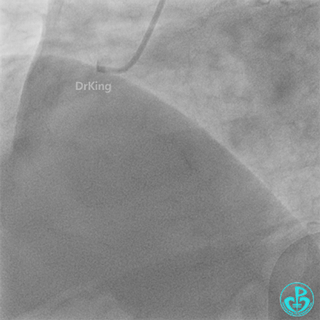 Haichang Wang: The Nightmare Case on Recurrent Subacute LAD Ostial Stent Thrombosis