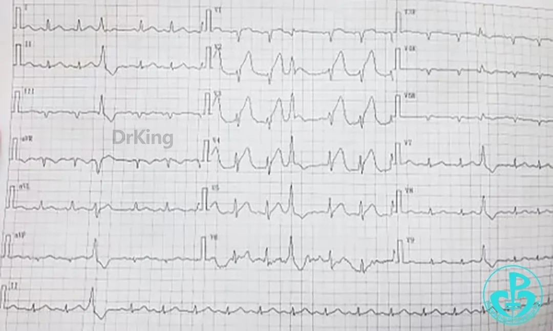 Haichang Wang: The Nightmare Case on Recurrent Subacute LAD Ostial Stent Thrombosis