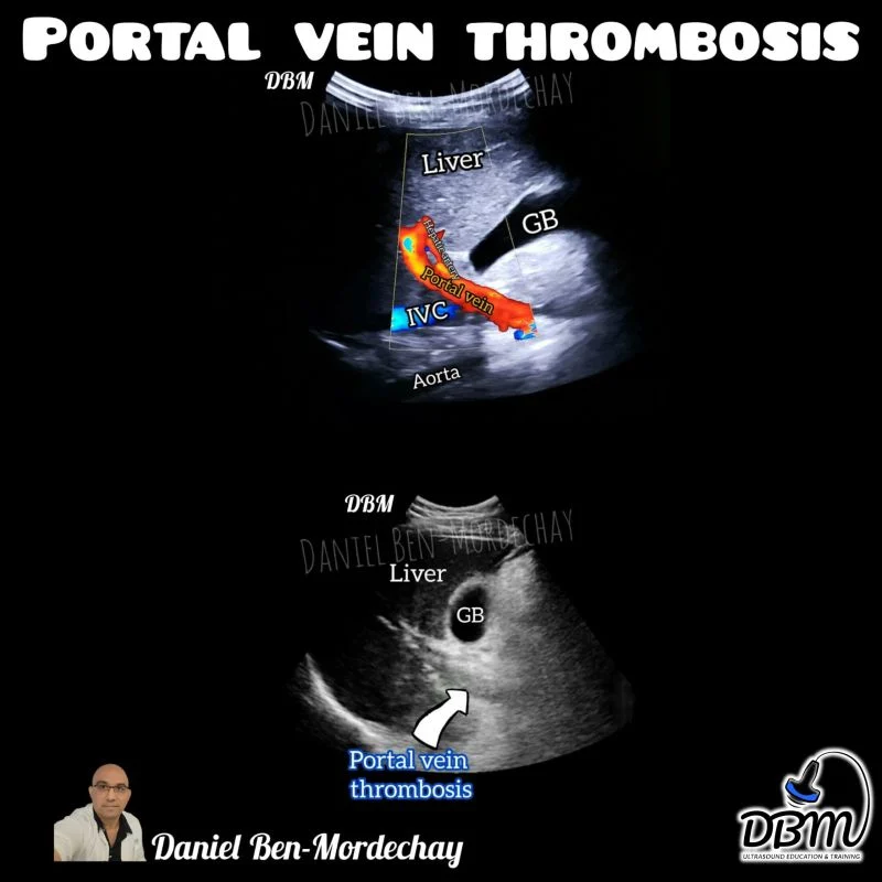 Daniel Ben-Mordechay: Portal Vein Thrombosis - Ultrasound Perspective 1 Daniel Ben-Mordechay: Portal Vein Thrombosis - Ultrasound Perspective