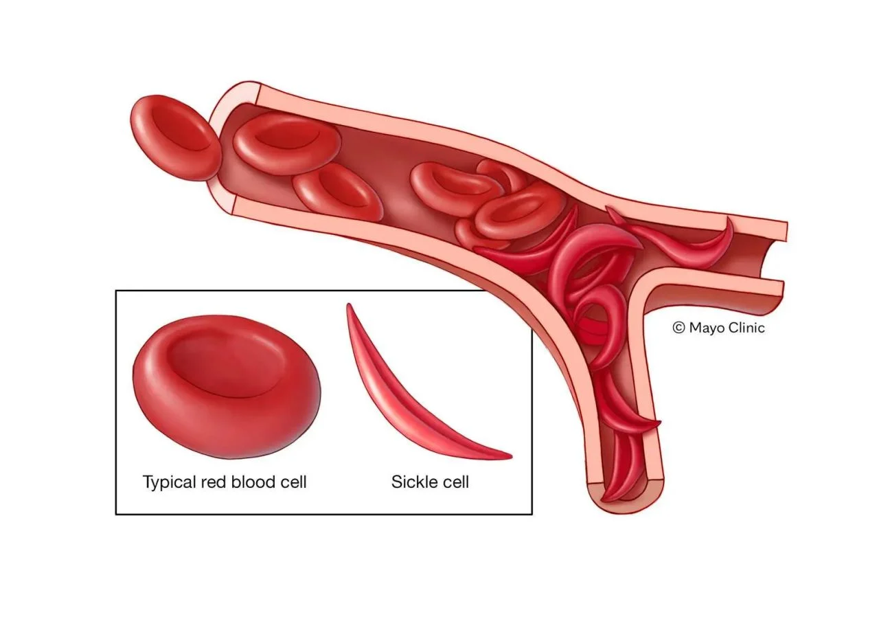Francis Appiah-Kubi: How Malaria Shaped the Evolution of Sickle Cell Disease