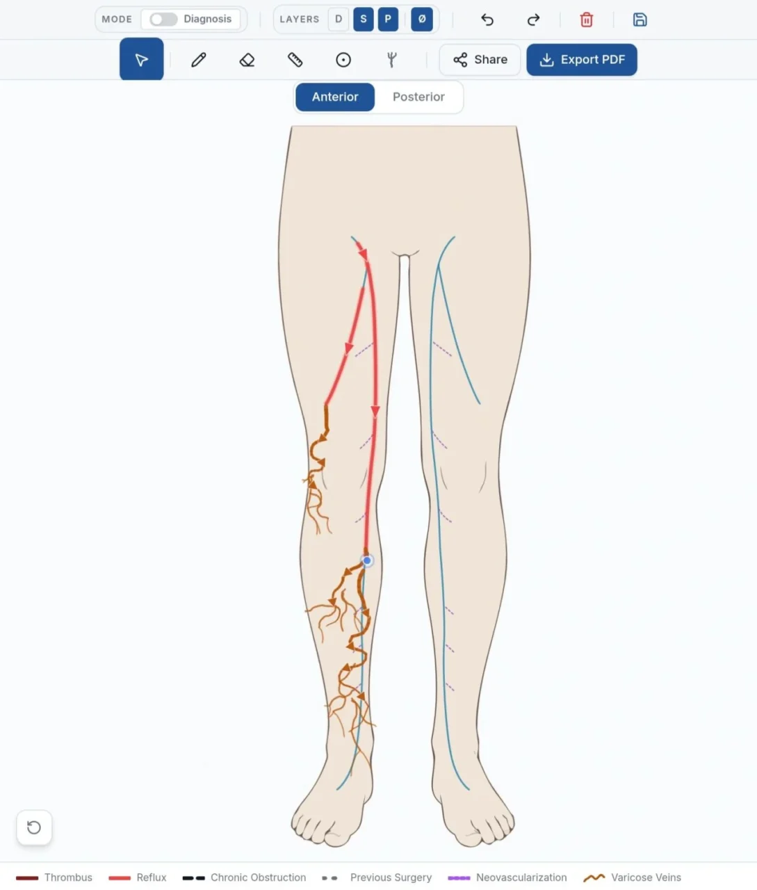 Vitor Ferreira: VeinPlanner Makes Complex Venous Planning More Efficient