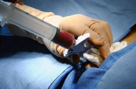Moustafa Abdou: Is the Bone Marrow Examination Still the 'Gold Standard'? 1 Moustafa Abdou