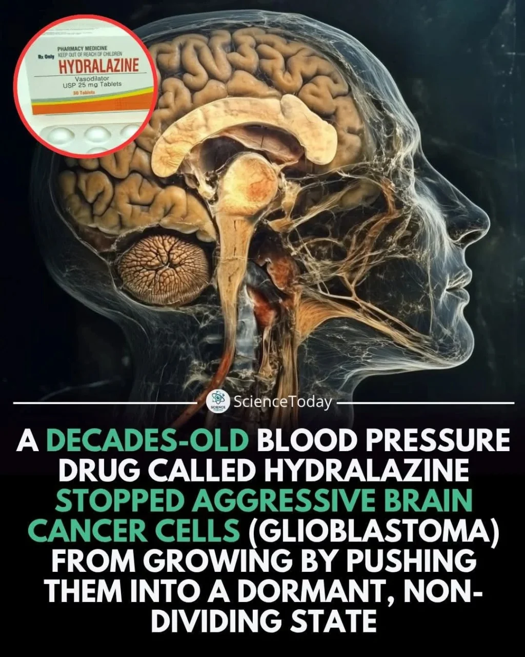 Saeed Ahmed Memon: Can Hydralazine Stop Aggressive Brain Cancer Cells?