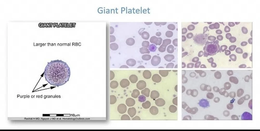 Seema Dawood: Decoding Giant Platelets in Coagulation and Bone Marrow Disorders