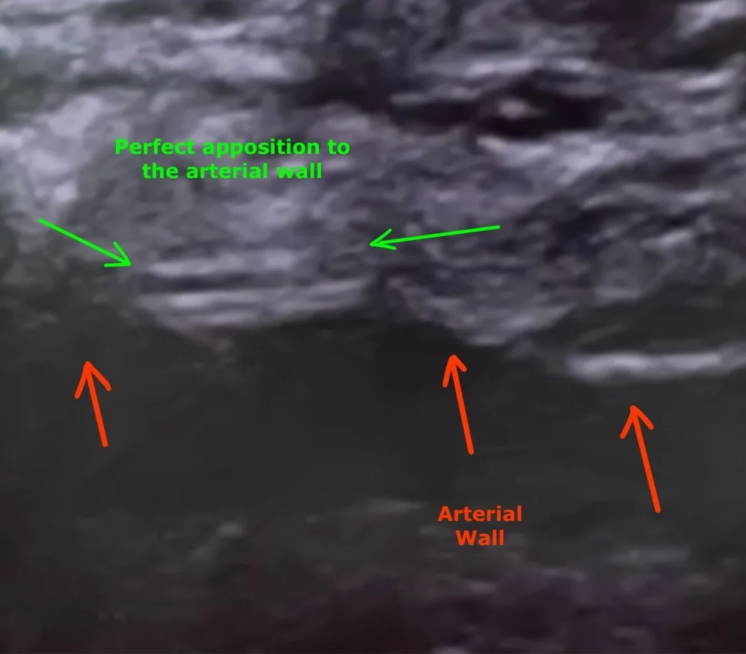 Giovanni Solimeno: When the Common Femoral Artery Wall is Diseased, Closure is Not a Step