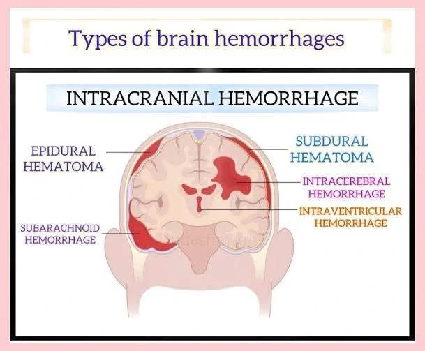 Rana Mohamed: Pediatric and Adult Patterns of Spontaneous Intracerebral Hemorrhage