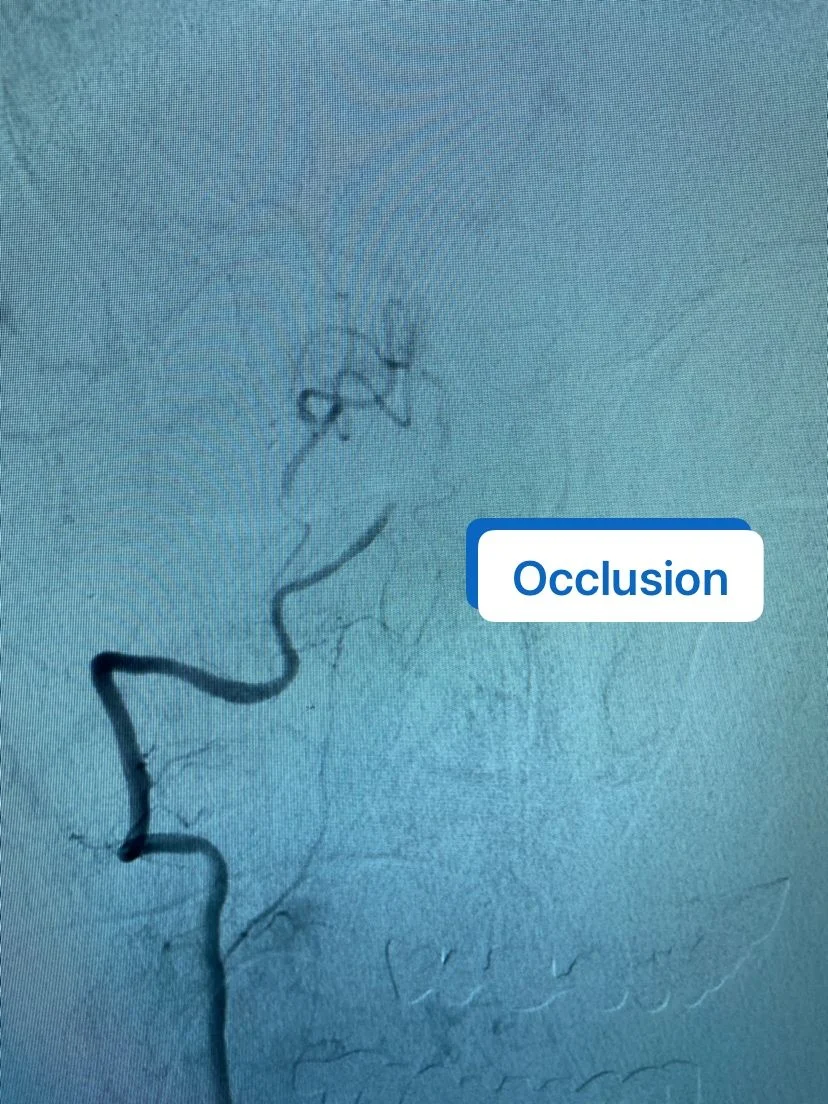 Gokhan Ozdemir: Managing Acute Flow Diverter Stent Thrombosis in a Critical Vertebrobasilar Circulation 1 Gokhan Ozdemir